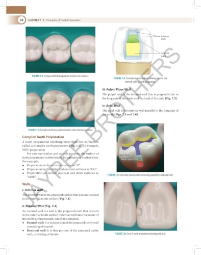Textbook of Preclinical Conservative Dentistry, 4/E for 2nd Year BDS Students | Dental Caries, Materials, Cast Metal, Amalgam and Composite Restorations | Viva Questions and Glossary