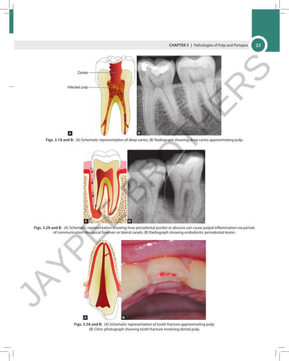 Textbook of Endodontics, 5/E for BDS, MDS Students and Practicing Dentists | Root Canal Guide with Rotary Instruments, Bioceramics, Vital Pulp Therapy | Chapter-wise University Exam Questions: 1